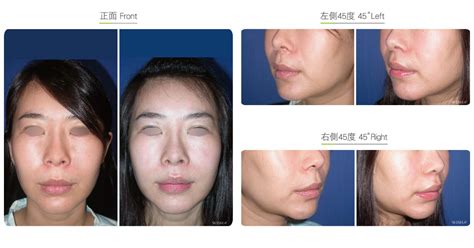 Philtrum Reduction-Facial Surgery | Wish Aesthetic Surgery Clinic