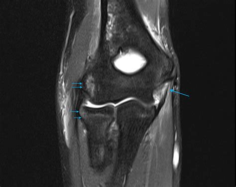 Elbow MRI - Paediatic MRI Series - GP Referred