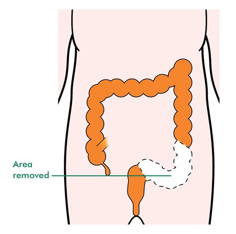 How Long Is Colon Cancer Surgery - CancerWalls