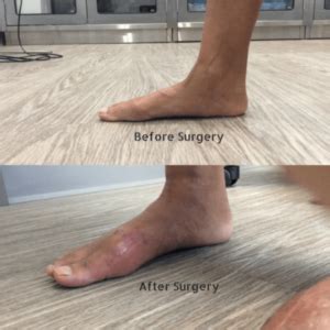 Flat Foot Reconstruction surgery | Foot and Ankle Wellness Centre