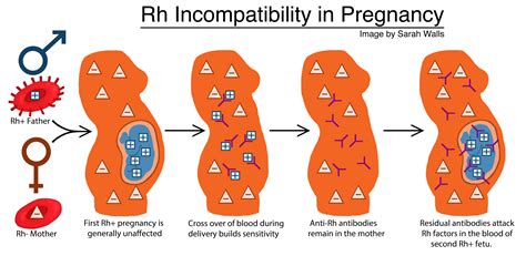 Rh Incompatibility in Pregnancy - Image | Embryo Project Encyclopedia