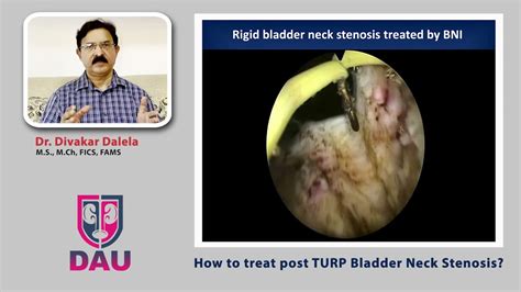 How to treat Post TURP bladder neck stenosis - YouTube