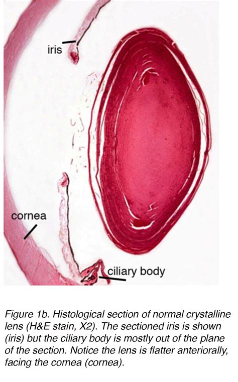 Crystalline Lens and Cataract by Joah F. Aliancy and Nick Mamalis – Webvision