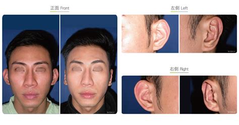 Bat Ear Correction (Otoplasty) - Facial Surgery | WishClinic