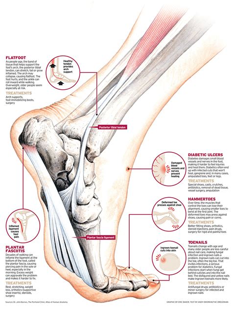 Foot Surgery // Explica Media