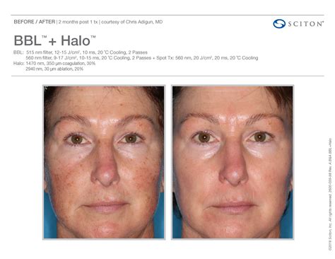 Fox Valley Plastic Surgery | Halo™ Laser Treatments