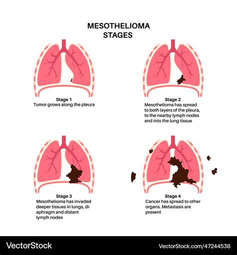 Mesothelioma cancer stages Royalty Free Vector Image