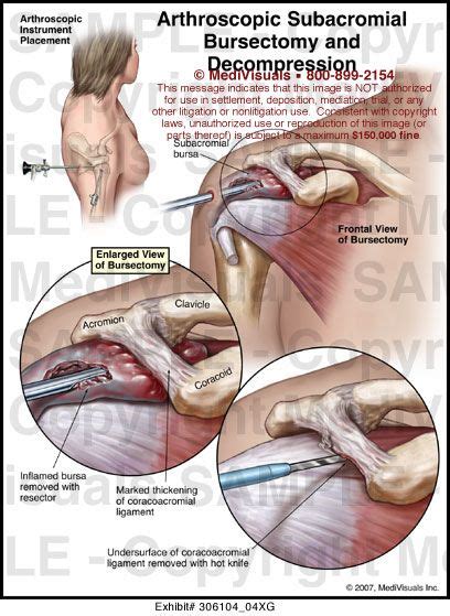 Arthroscopic Subacromial Bursectomy and Decompression Medivisuals | Shoulder arthroscopy ...