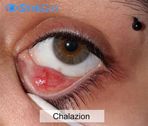 Chalazion | StyeGuy