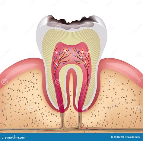 Dental Caries Stage Vector Poster Banner Template | CartoonDealer.com #131727662