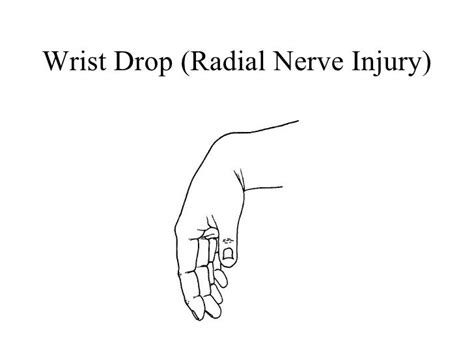 Wrist Drop Cause, Symptoms,Diagnosis, Treatment, Exercise