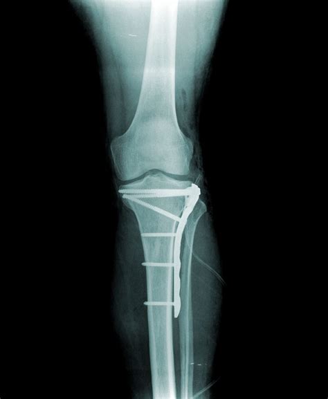 Tibial Plateau Fracture | Dr Geier