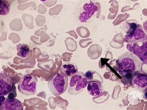 Cabot ring in Chronic Myeloid Leukemia