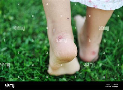 Callus finger hi-res stock photography and images - Alamy