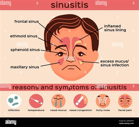 Nasal disease flat infographics layout with reasons and symptoms of sinusitis vector ...