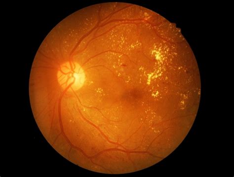 CPAP Compliance in OSA and Type 2 Diabetes Lowers Risk for Diabetic Retinopathy - Pulmonology ...