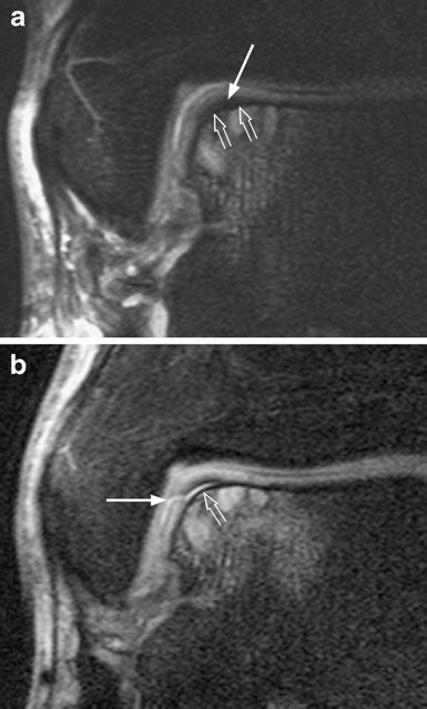 Grade 2a osteochondral lesion central medial aspect talar dome ...