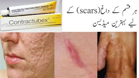 Treatment of every type of scars || Contractubex gel uses || Health ...