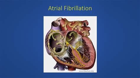 VIDEO: Normal, Skipped, or Irregular Heart Beats: Does My Heart Rate Determine My Fate? - UCSD ...