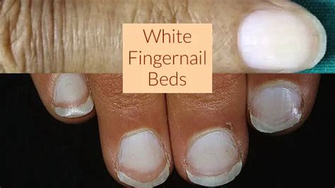 White Fingernail Beds - What It Means - Get Long Nails