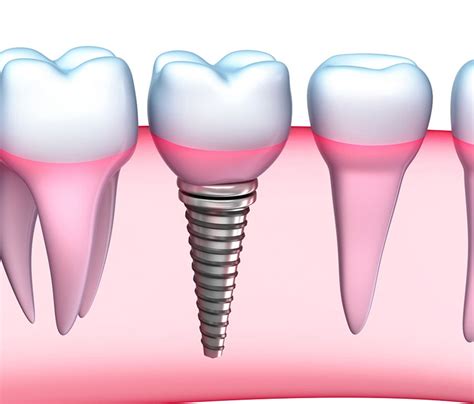 Dental Implants: Know the Risks - Newport Beach Dental Associates