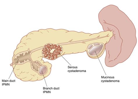 Pseudocyst Of Pancreas