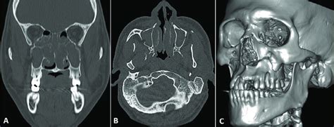 Case 1 -Computed tomography scan showing the Le Fort I fracture: (A)... | Download Scientific ...