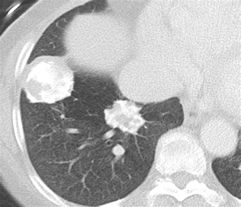 Icd 10 Code For Necrotizing Granuloma Of Lung