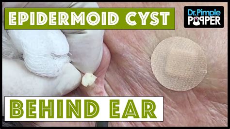 Painful Cyst Behind Ear