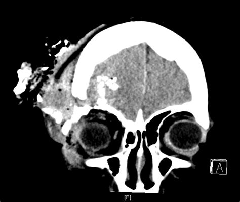 Right Pterional Craniotomy for Penetrating Head Injury - cns.org