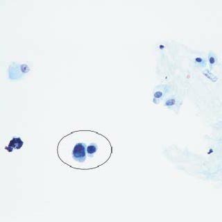 (PDF) Urine and bladder washing cytology for detection of urothelial carcinoma: Standard test ...