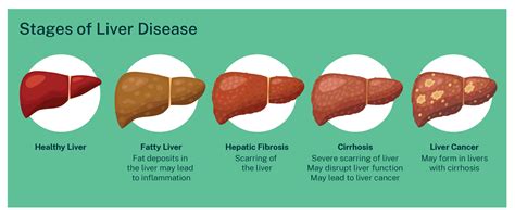 Stages Of Liver Disease Photograph By Kateryna Konsci - vrogue.co