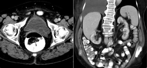 Ureterocele