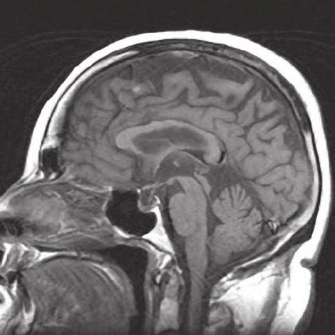 (PDF) Corticobasal Degeneration