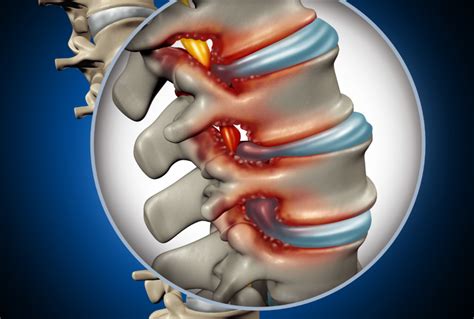 Relieve Nerve Compression Archives - Spinal Backrack