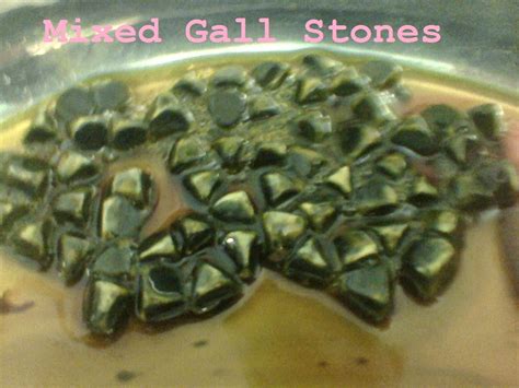 Introduction of Gallbladder Stones (Cholelithiasis) « General Surgical Operations