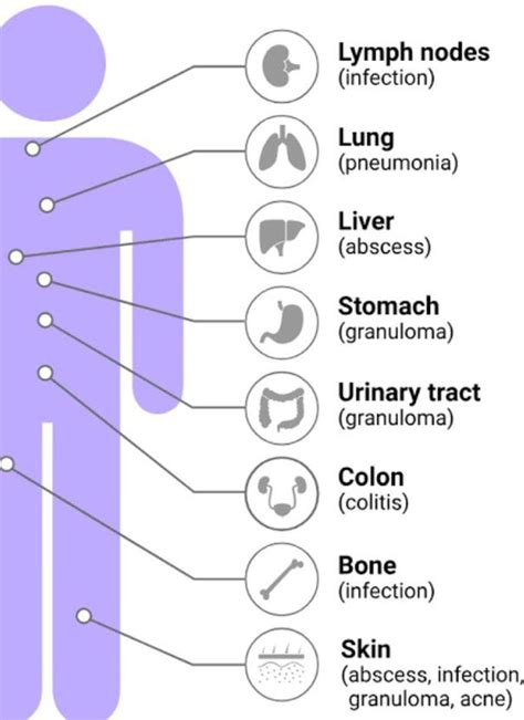 Symptoms of Granuloma - MEDizzy