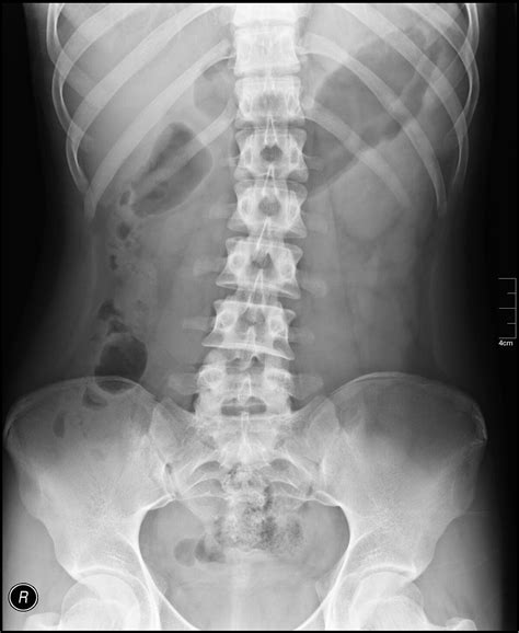 Abdominal x-ray - Wikipedia
