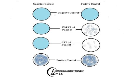 T-SPOT. Test For Mycobacterium Tuberculosis - Medical Laboratory ...