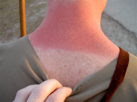 File:Sunburn Treatment Practices.jpg - Wikimedia Commons