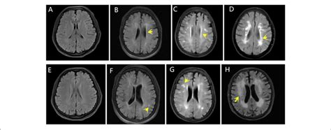 | Fazekas scores. The yellow arrows indicate WMLs on FLAIR MRI. The PV ...