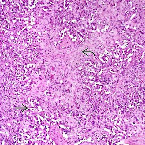 Epithelioid Hemangioendothelioma | Basicmedical Key