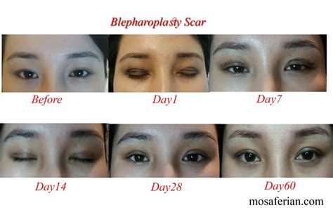 two week upper eyelid surgery recovery day by day Archives