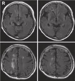 Magnetic resonance images showing white matter lesions near the right...