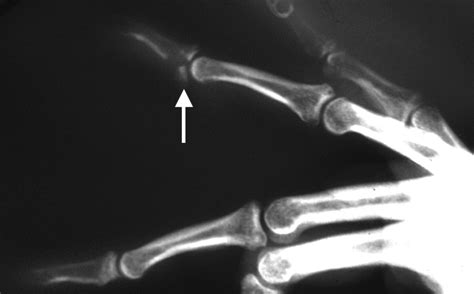 FINGER DISTAL PHALANX FRACTURES | Hand Surgery Resource