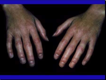 Woundbiotech - Wounds:Common and Uncommon - Scleroderma and Scleroderma ...