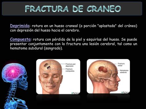 PPT - Fractura de Cráneo PowerPoint Presentation, free download - ID:231055