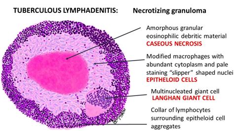 Caseous Necrosis Histology