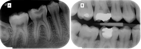 Caries Radiography