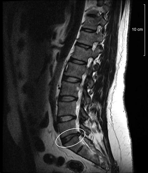 Resonancia magnética en la región lumbar - Diagnóstico Especializado por Imagen